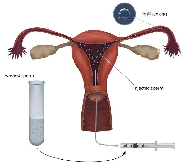 How Does ICI Insemination Work at Home